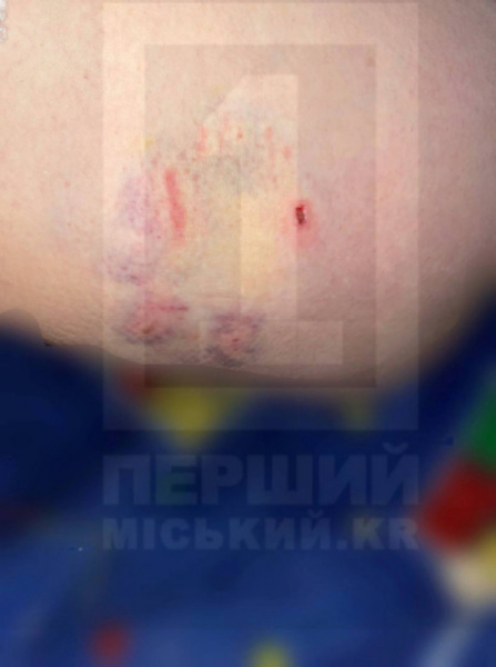 У Кривому Розі бродяча собака покусала жінку0