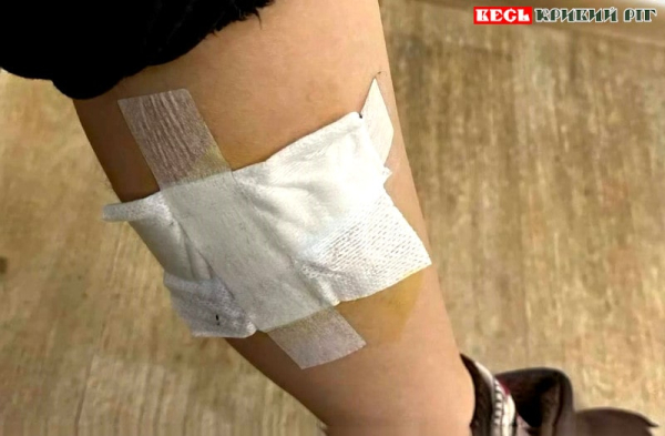 Дівчину вкусила бездомна собака на Даманському в Кривому Розі