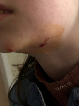 У Кривому Розі бродячий пес напав на 9-річну дівчинку