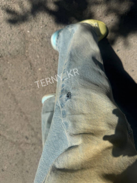 У Кривому Розі на мікрорайоні Даманський безпритульний собака покусав дівчину2