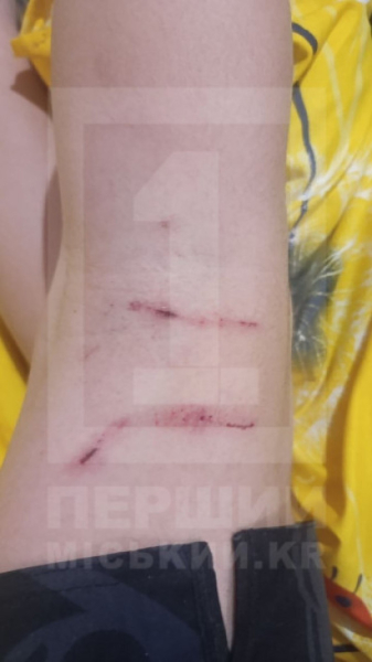 У Кривому Розі вуличний собака напав на 13-річну дитину0